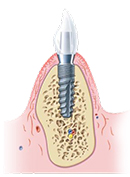 ende-implantat