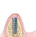 schritt3 einheilphase