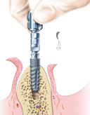 setzen implantat